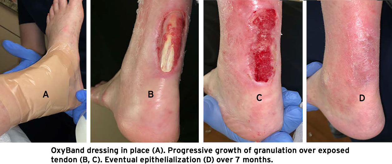 Use of OxyBand published in Vascular Disease Management, "The Achilles Tendon Vascular Flow is Achilles’ True Weakness"